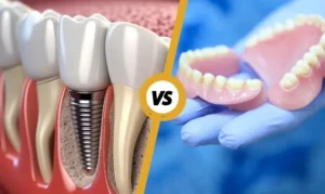Dental-Implants-Vs-Denture-Dental-Implants-Austin-BLVD-Dentistry-Orthodontics