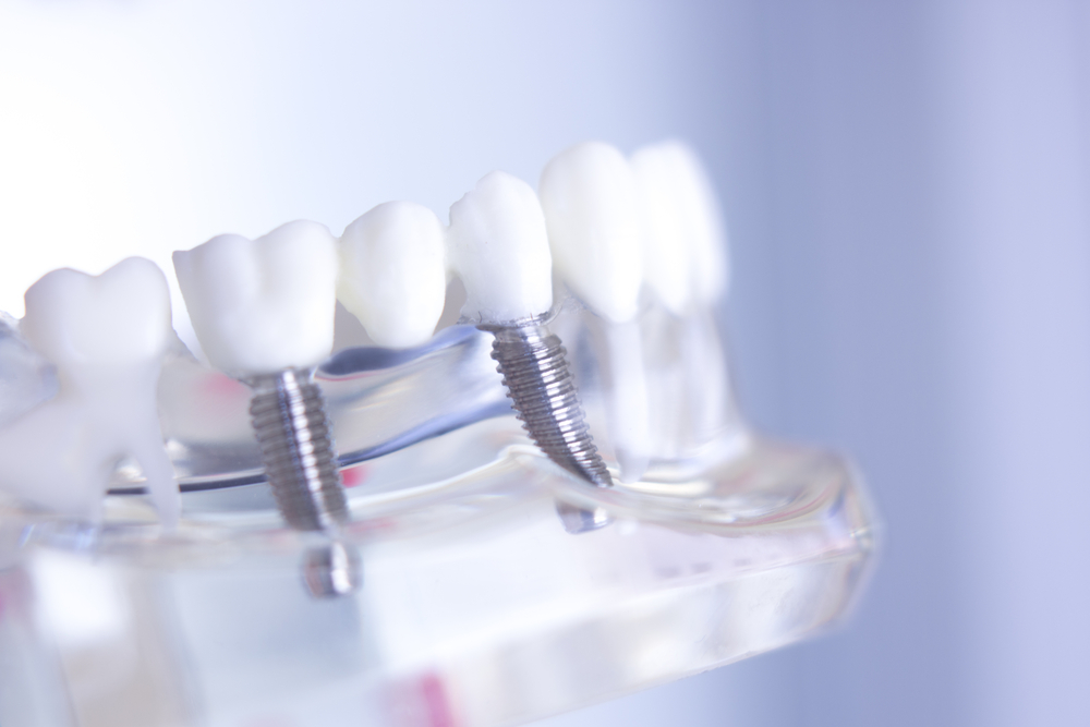 Dentist explains dental implant options to a patient in a modern office.